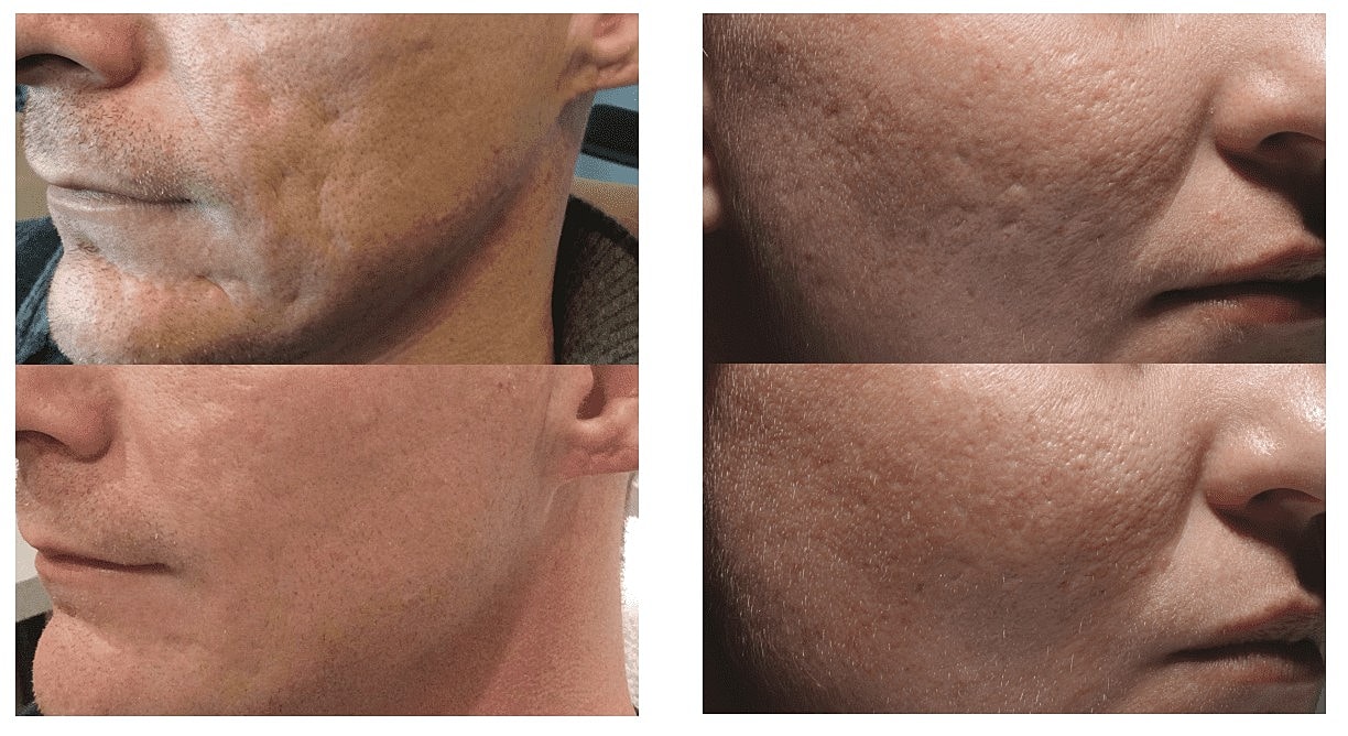 Discover Why Everyone Is Raving About Bellafill, the Dermal Filler With Results That Last 5 Years - Image 3