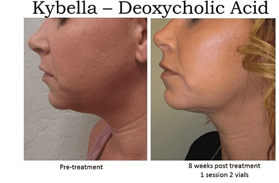 Ditch the Dreaded Double Chin With Kybella - Image 2