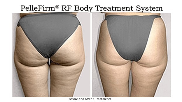 Fight Back Against Cellulite in 2019 - Image 2