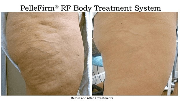 Fight Back Against Cellulite in 2019 - Image 3