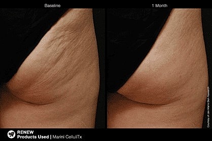 Fight Back Against Cellulite in 2019 - Image 4