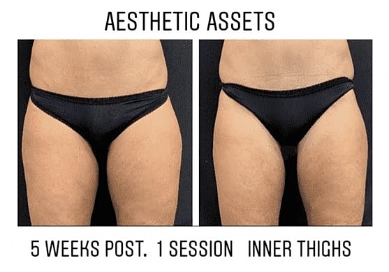 Finish Off Your Weight-Loss Journey with CoolSculpting - Image 2