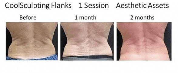 Finish Off Your Weight-Loss Journey with CoolSculpting - Image 3