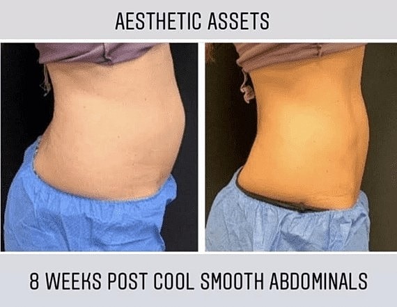 Finish Off Your Weight-Loss Journey with CoolSculpting - Image 4
