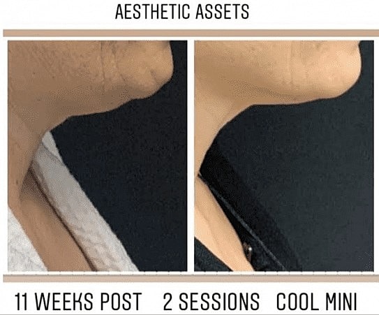 Finish Off Your Weight-Loss Journey with CoolSculpting - Image 5