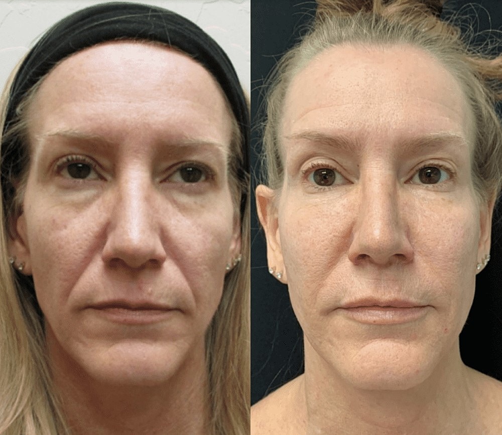 Get a Facelift Without the Knife - Image 3