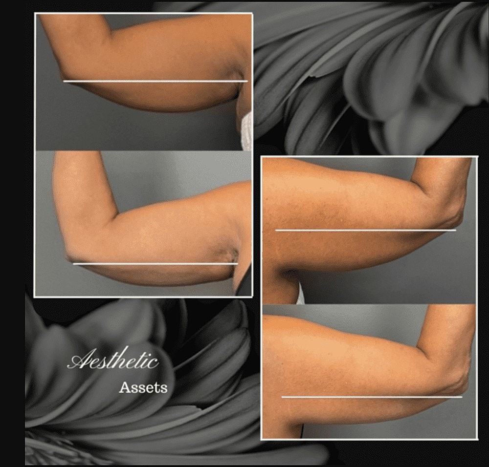 Get Your Body Swimsuit Ready With CoolSculpting® - Image 2