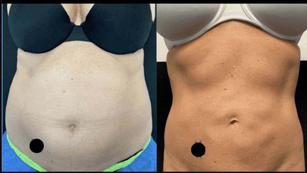 Get Your Body Swimsuit Ready With CoolSculpting®