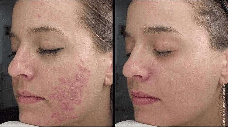 Greet the New Year With Revitalized Skin Through Microneedling - Image 3