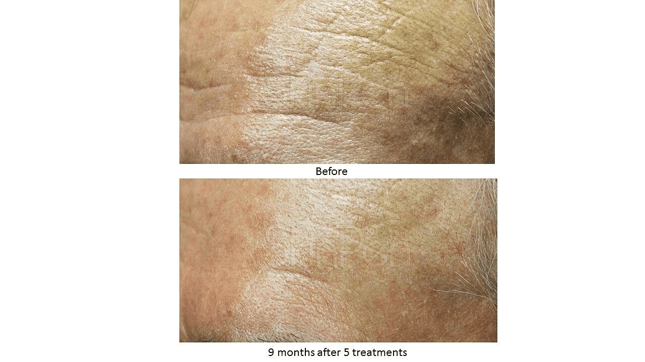 Greet the New Year With Revitalized Skin Through Microneedling - Image 4