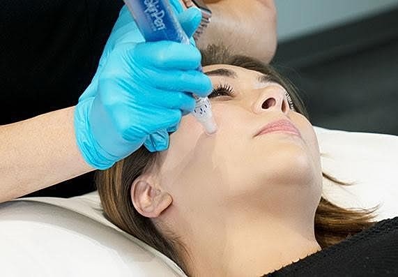 Greet the New Year With Revitalized Skin Through Microneedling