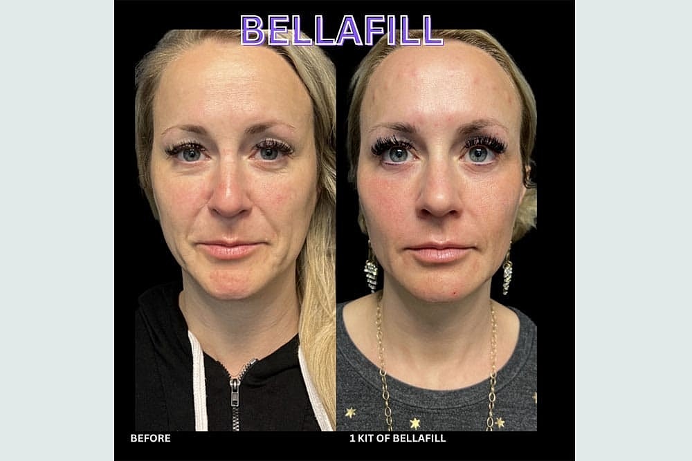 Grow New Collagen Naturally with Sculptra & BellaFill - Image 4