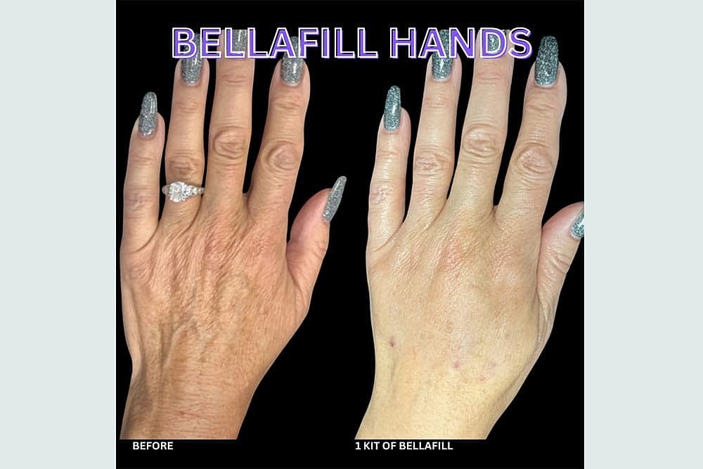 Grow New Collagen Naturally with Sculptra & BellaFill - Image 5