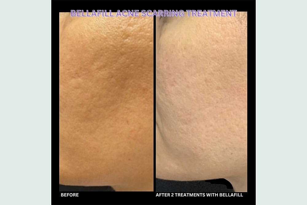 Grow New Collagen Naturally with Sculptra & BellaFill - Image 6
