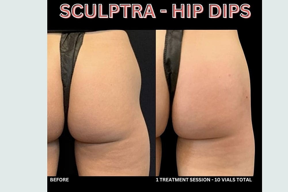 Grow New Collagen Naturally with Sculptra & BellaFill