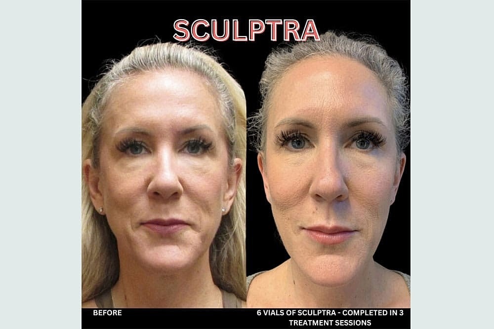 Grow New Collagen Naturally with Sculptra & BellaFill - Image 2