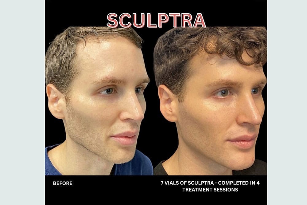 Grow New Collagen Naturally with Sculptra & BellaFill - Image 3