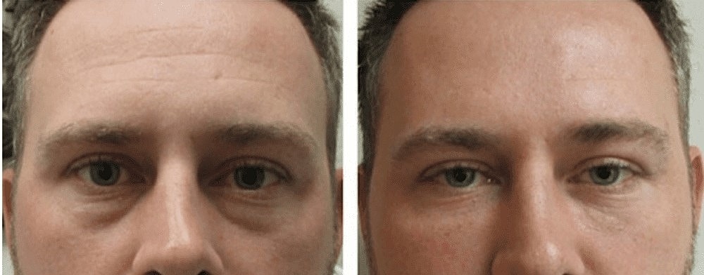 How Do Dermal Fillers Work? - Image 2