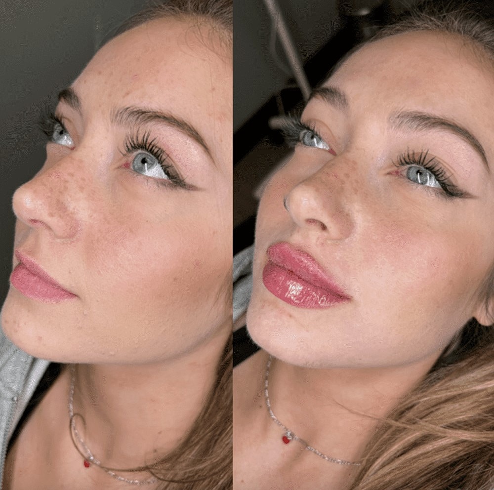 How Do Dermal Fillers Work? - Image 3