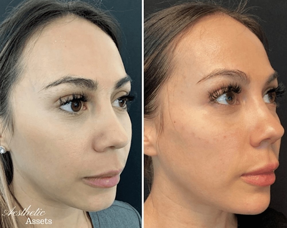 How Do Dermal Fillers Work? - Image 4