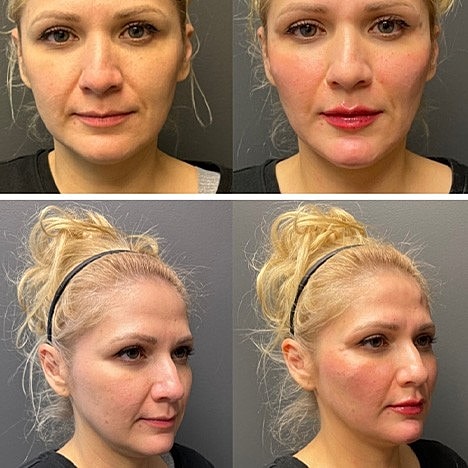 How Long Do Dermal Fillers Last? - Image 2
