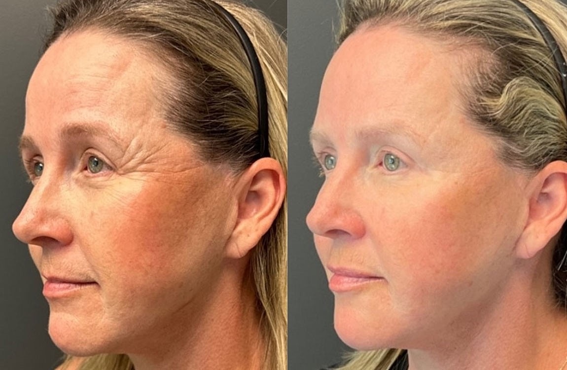 How Much Does Botox Cost in Scottsdale? - Image 3
