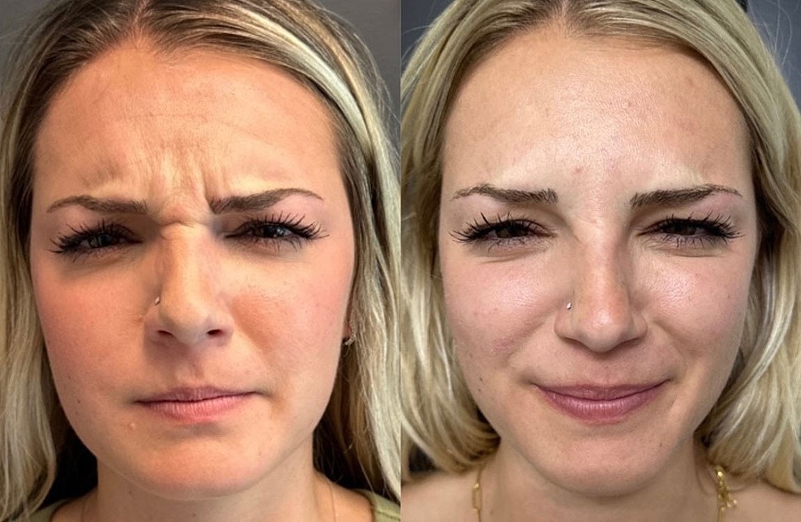 How Much Does Botox Cost in Scottsdale? - Image 4