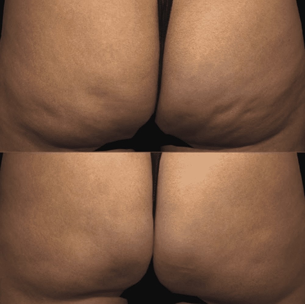 It’s HERE! QWO, an Injectable Treatment for Cellulite - Image 2