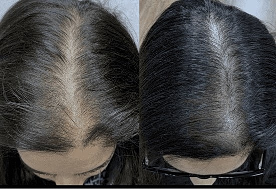 Keralase™: The Intelligent Solution for Hair Loss - Image 6