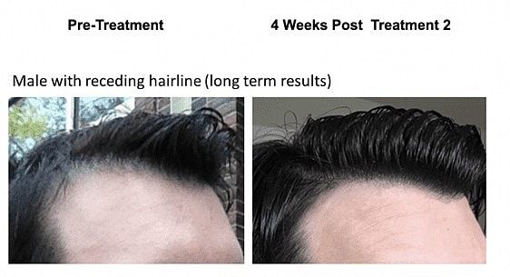 Keralase™: The Intelligent Solution for Hair Loss - Image 7