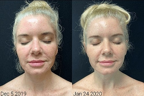 LaseMD Ultra: The cutting edge technology that delivers glowing skin for all skin types! - Image 2