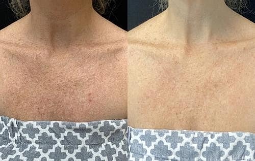 LaseMD Ultra: The cutting edge technology that delivers glowing skin for all skin types! - Image 4