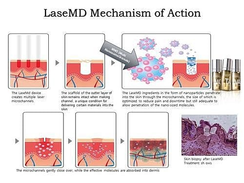 LaseMD Ultra: The cutting edge technology that delivers glowing skin for all skin types! - Image 5