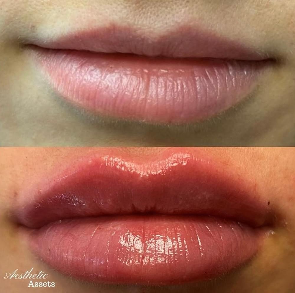 Look Your Very Best In Time For the Holidays With Injectables - Image 2