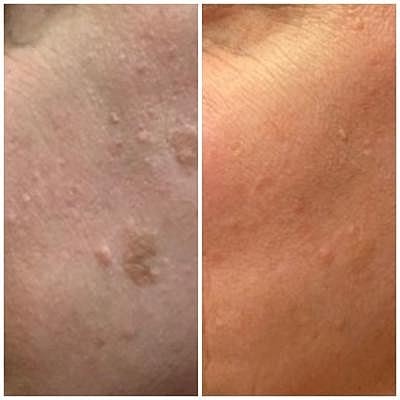 Looking For Gentle Summer Treatment? — Try our Get Your Glow ON Package with LaseMD® and DiamondGlo - Image 2