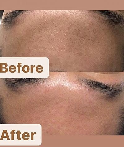 Looking For Gentle Summer Treatment? — Try our Get Your Glow ON Package with LaseMD® and DiamondGlo - Image 3