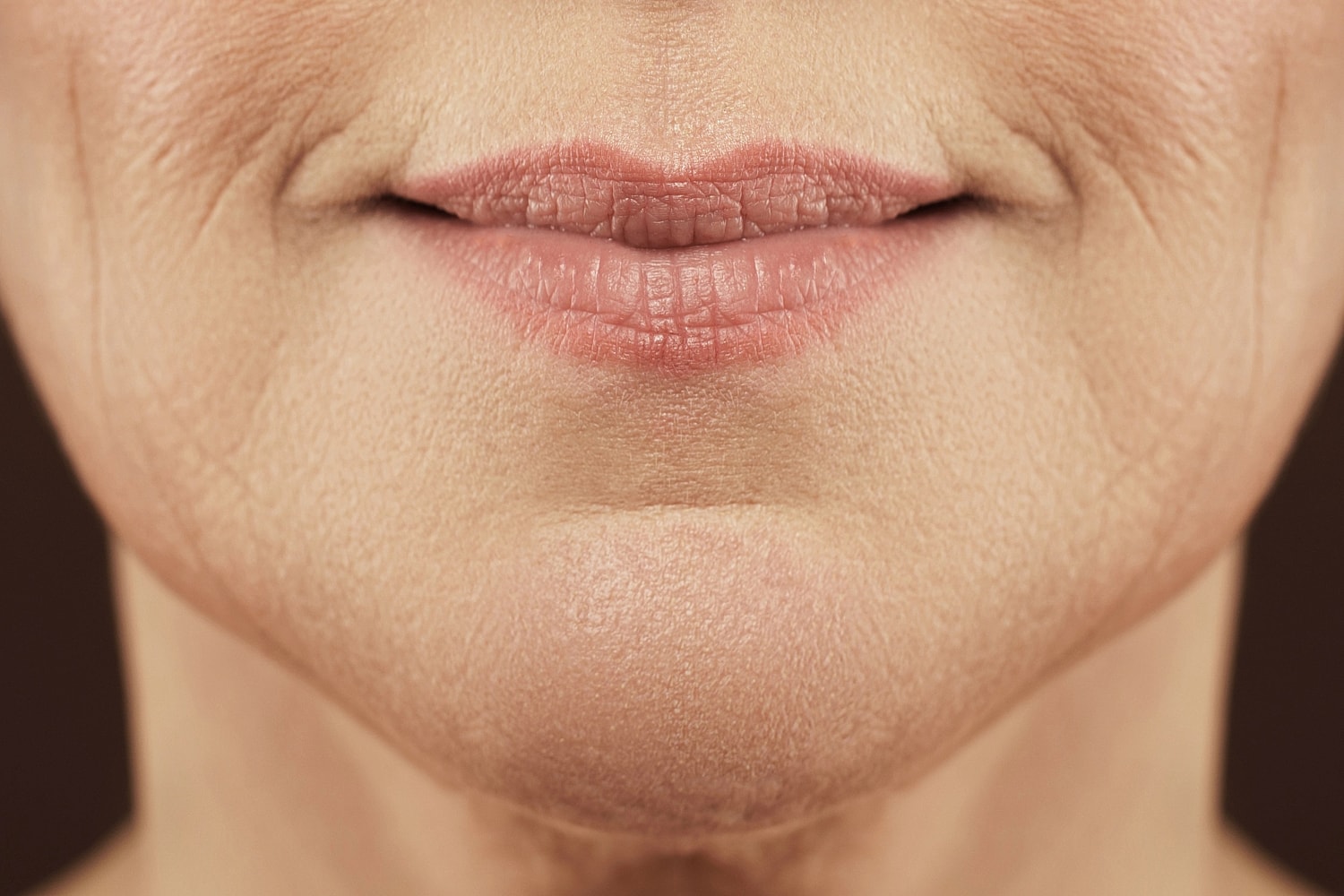Nasolabial Folds vs. Marionette Lines: Choosing the Right Filler - Image 3