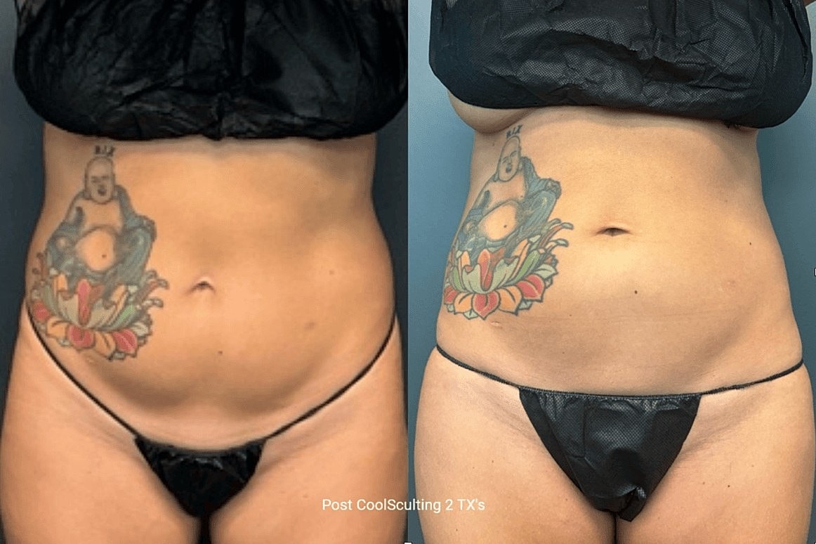 New Year, New You: Body Sculpting Specials at Aesthetic Assets - Image 3