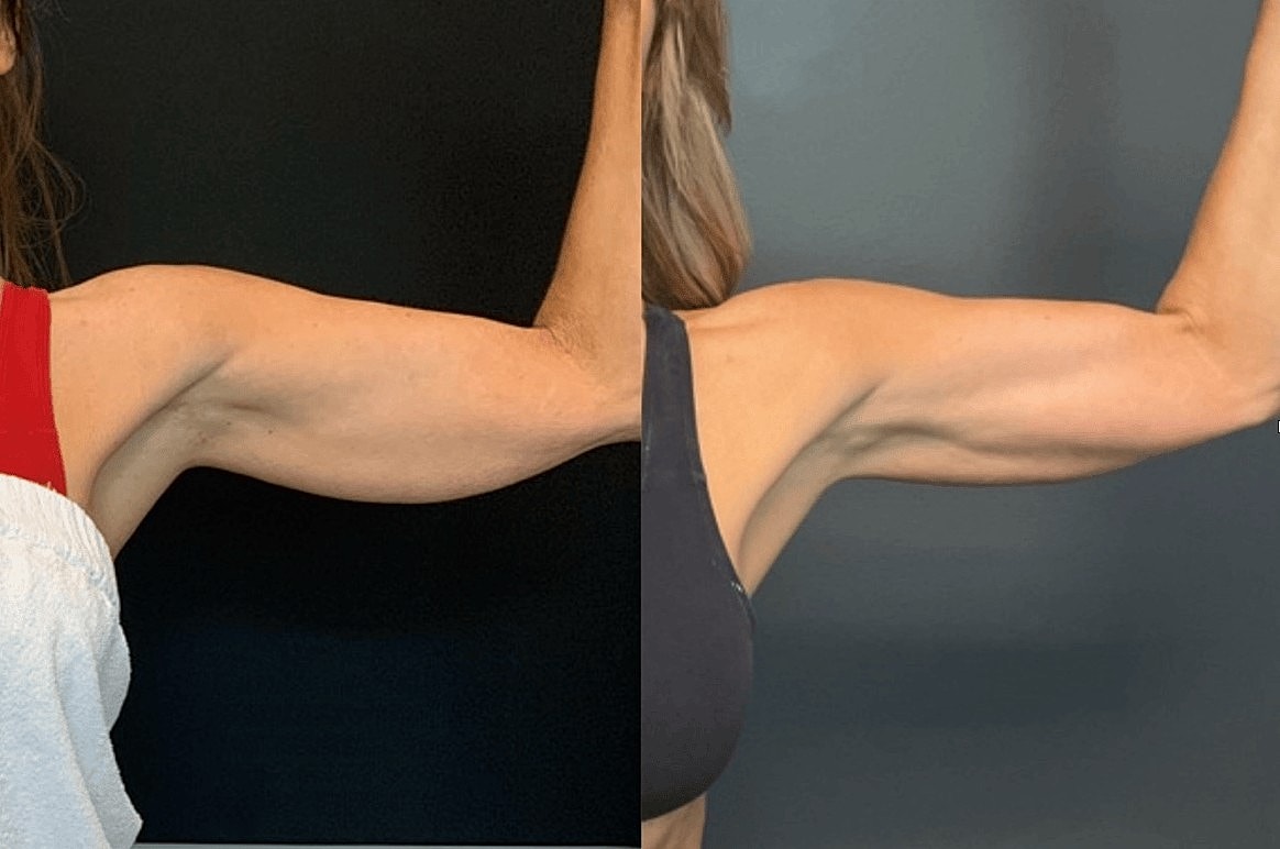 New Year, New You: Body Sculpting Specials at Aesthetic Assets - Image 2