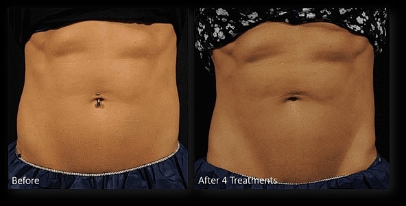 Next Level in Body Sculpting with Lutronic Accufit™ - Image 4