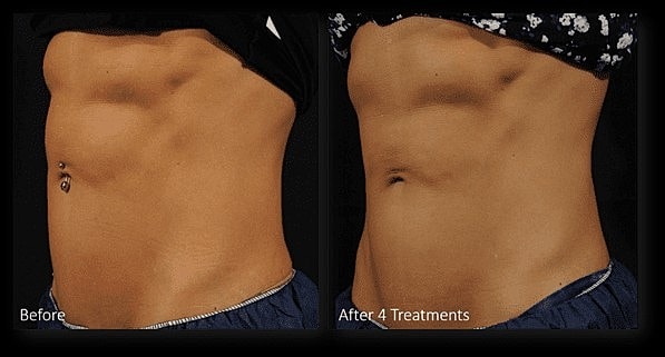 Next Level in Body Sculpting with Lutronic Accufit™ - Image 5