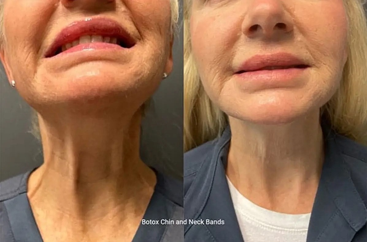 botox chin and neck bands