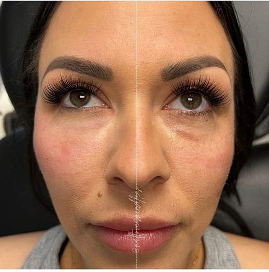 PRP vs. PRF and EZ Gel: Which is Better? - Image 3