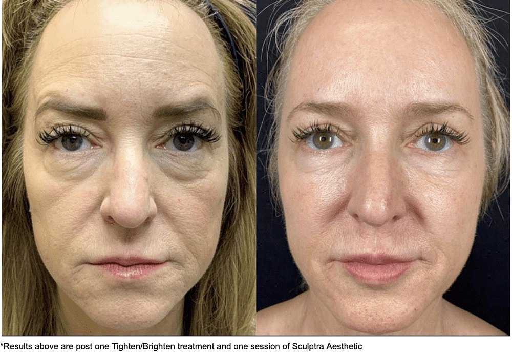 Put Your Best Face Forward This Year With The Total Skin Solution by Lutronic - Image 2