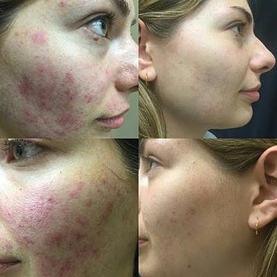 Put Your Best Face Forward With Our Breakout-Buster Regimen - Image 2