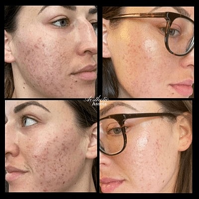 Put Your Best Face Forward With Our Breakout-Buster Regimen - Image 4