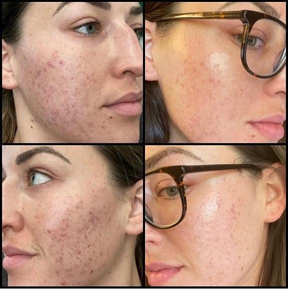Replenish Sun-Damaged Skin With a Diamond Glow (Dermal Infusion) Treatment