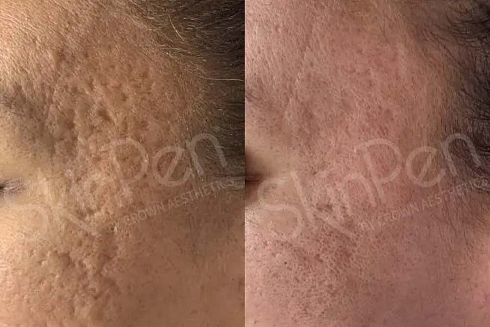 RESURFACE LAST YEAR AWAY NEW YEAR BETTER SKIN
