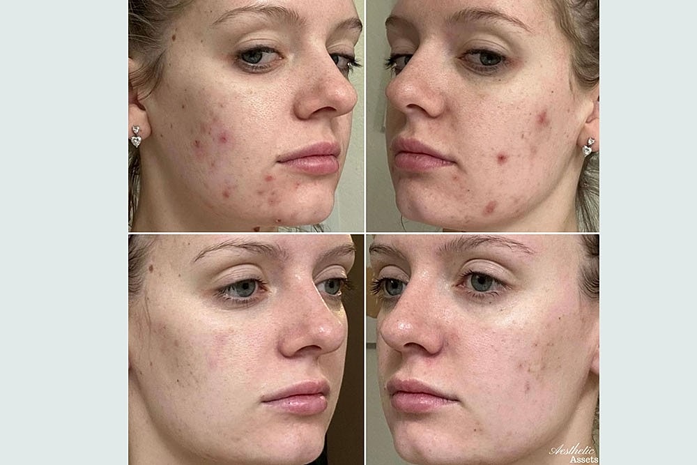 RESURFACE LAST YEAR AWAY NEW YEAR BETTER SKIN - Image 3