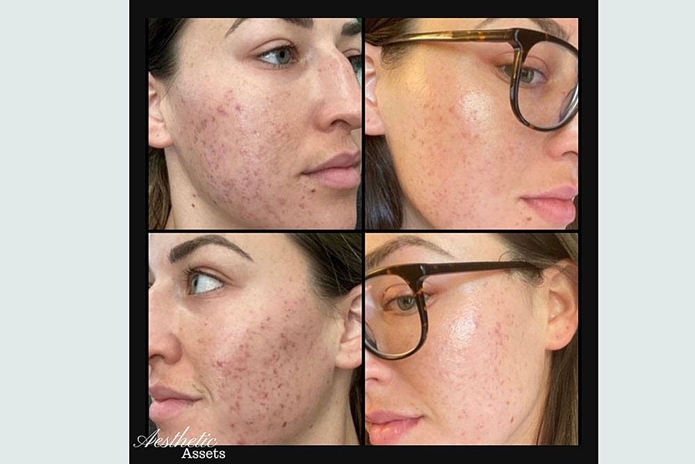 RESURFACE LAST YEAR AWAY NEW YEAR BETTER SKIN - Image 4